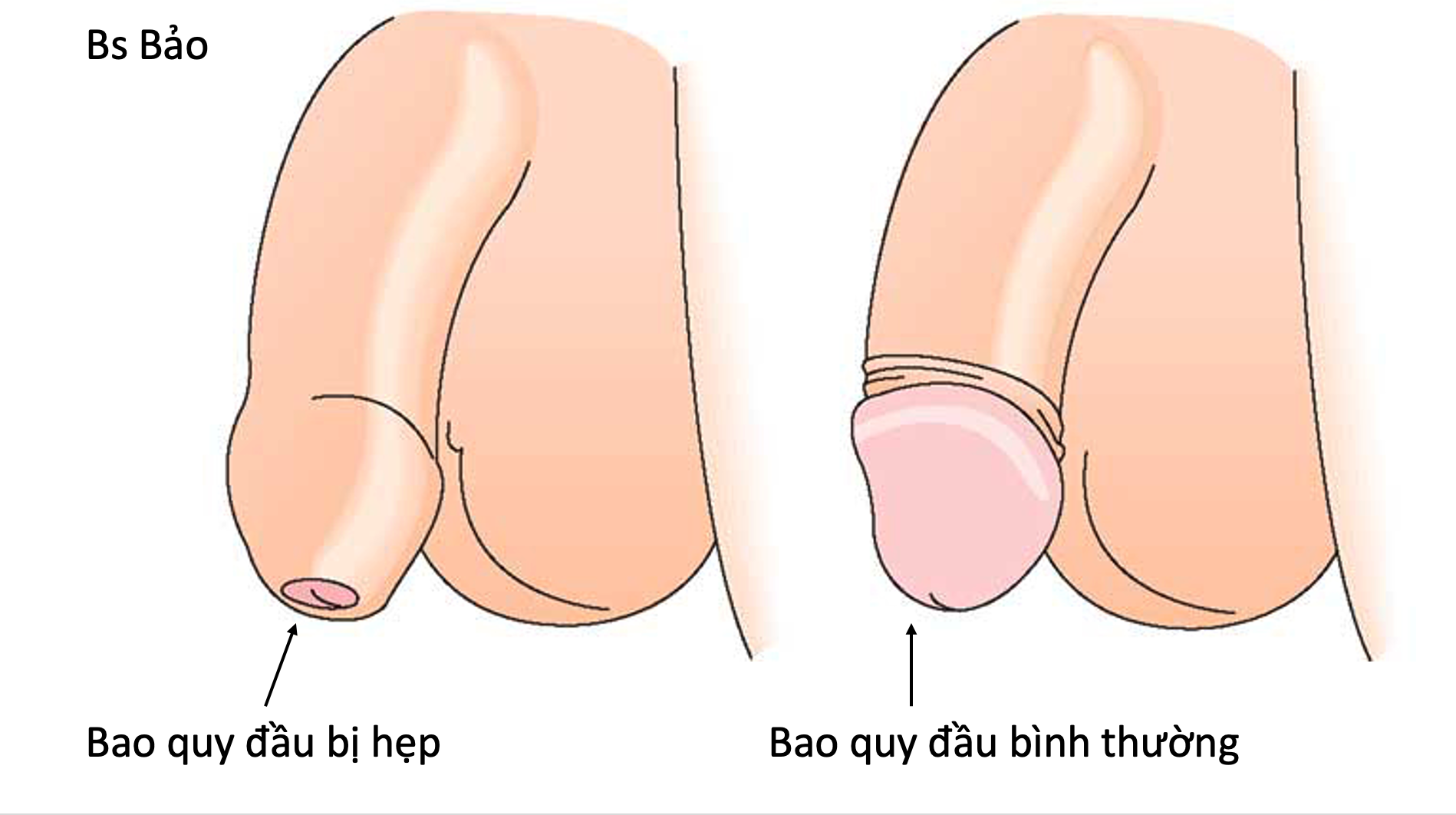 Hẹp bao quy là gì? Cách nhận biết và điều trị