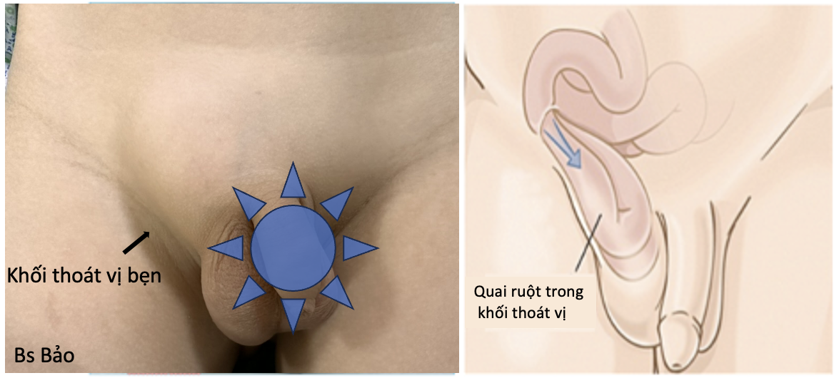 Thoát vị bẹn ở trẻ em: Biểu hiện và biến chứng thường gặp