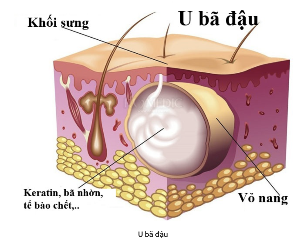 U bã đậu là gì? biểu hiện và cách điều trị