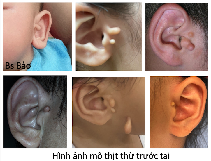 Dị tật mô thịt thừa trước tai ở trẻ em và cách điều trị