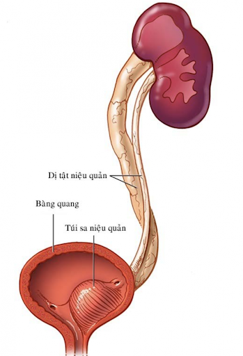 Thận niệu quản đôi: biểu hiện và cách điều trị