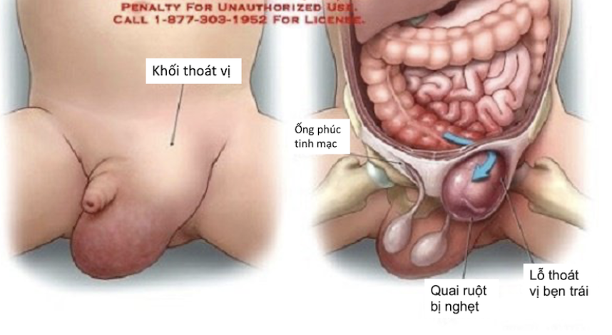 Thoát vị bẹn nghẹt ở trẻ em: Biểu hiện và cách điều trị