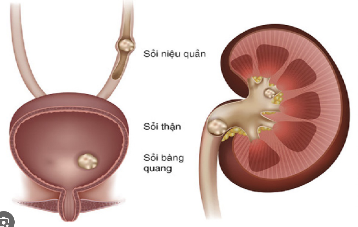 SỎI NIỆU (SỎI THẬN, SỎI NIỆU QUẢN, SỎI BÀNG QUANG)