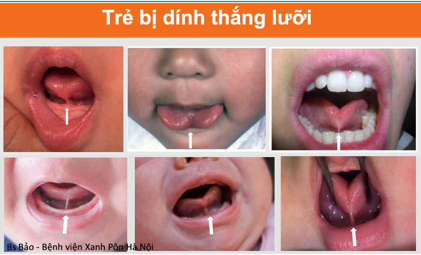 ĐIỀU TRỊ DÍNH THẮNG LƯỠI Ở TRẺ EM