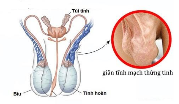 GIÃN TĨNH MẠCH THỪNG TINH