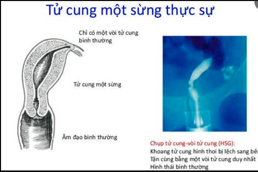 DỊ DẠNG TỬ CUNG MỘT SỪNG