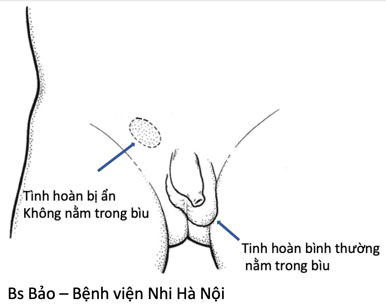 Điều trị ẩn tinh hoàn ở trẻ em