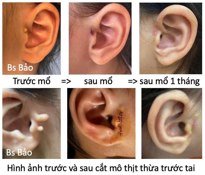 Điều trị tật Mô thịt thừa ở tai trẻ